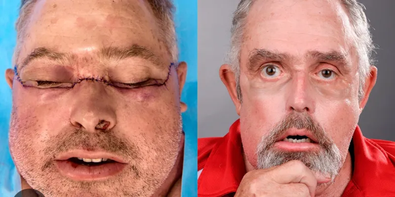 la-peau-du-visage-dun-donneur-recemment-decede