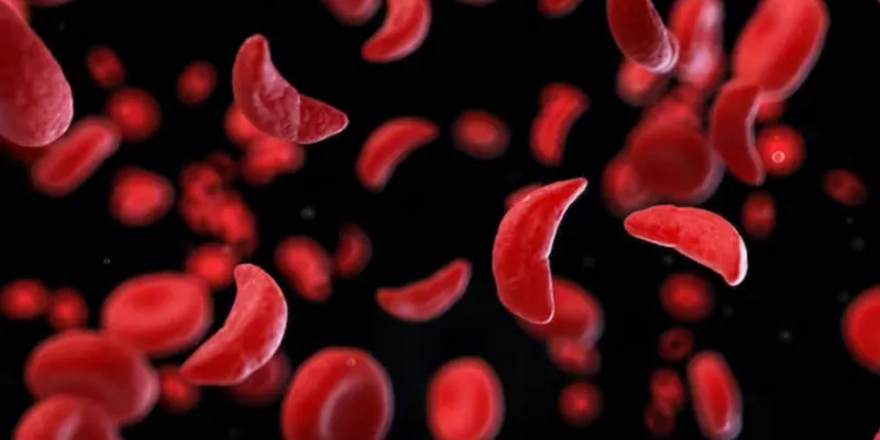 sante-la-drepanocytose-cette-tueuse-silencieuse