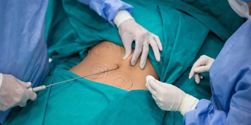 les-dangers-de-loperation-de-chirurgie-esthetique-des-fesses