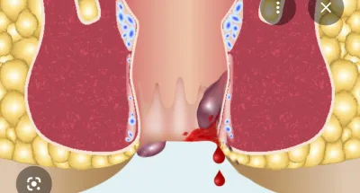 quest-ce-que-les-hemorroides