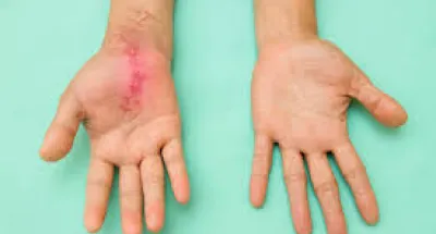soins-dermatologiques-comment-traiter-une-cicatrice